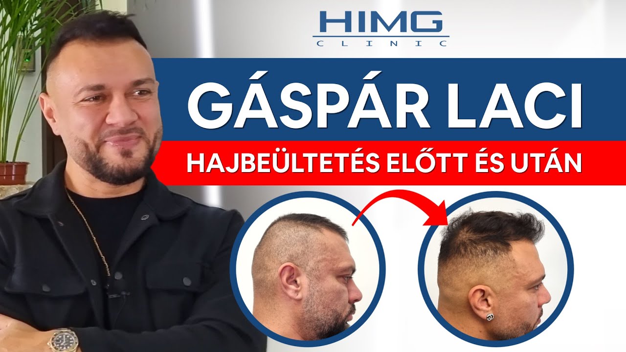 Gáspár Laci Hajbeültetése - HIMG Hajbeültetési Klinika