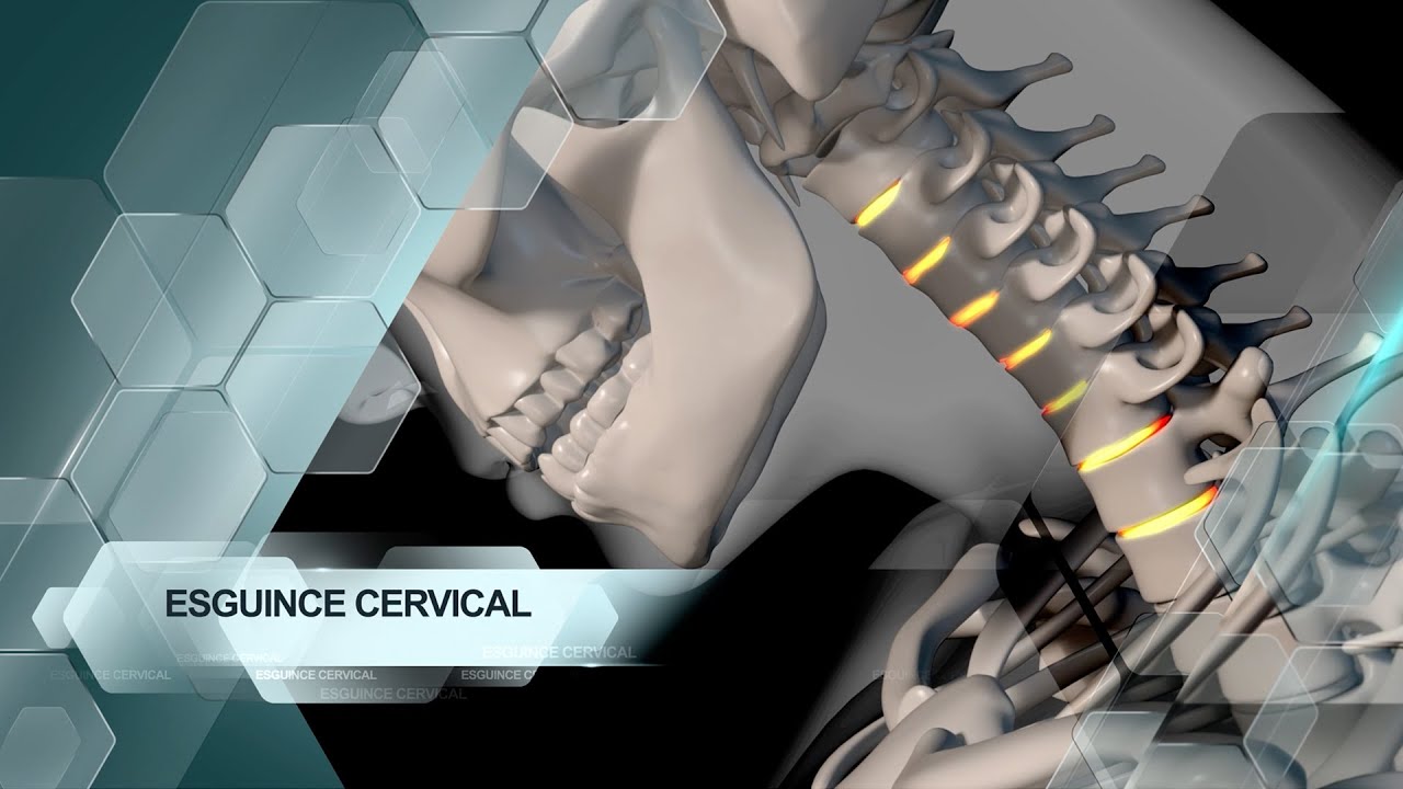 Esguince Cervical