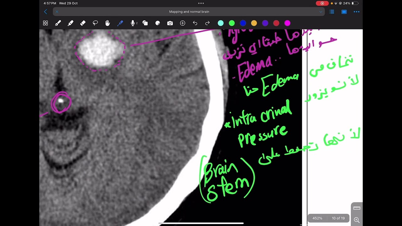 شرح راديولوجي الدماغ الاناتومي Mapping the Normal Brain CT and MRI Essentials