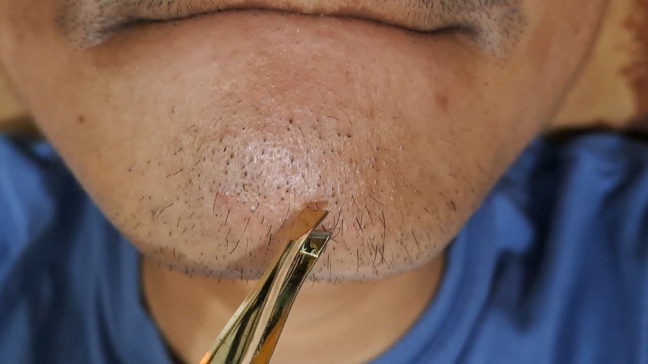 Satisfying moment, saat cabut rambut jenggot | #11  #hairremoval #tweezer #plucking 
