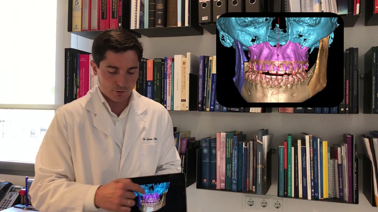 Planificación 3D - Maxilonet - Cirugía oral y maxilofacial