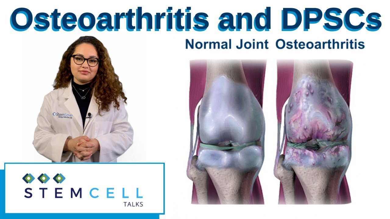 Osteoarthritis Treated With DPSCs | Best Treatment for Osteoarthritis in Knees | StemSave Inc.
