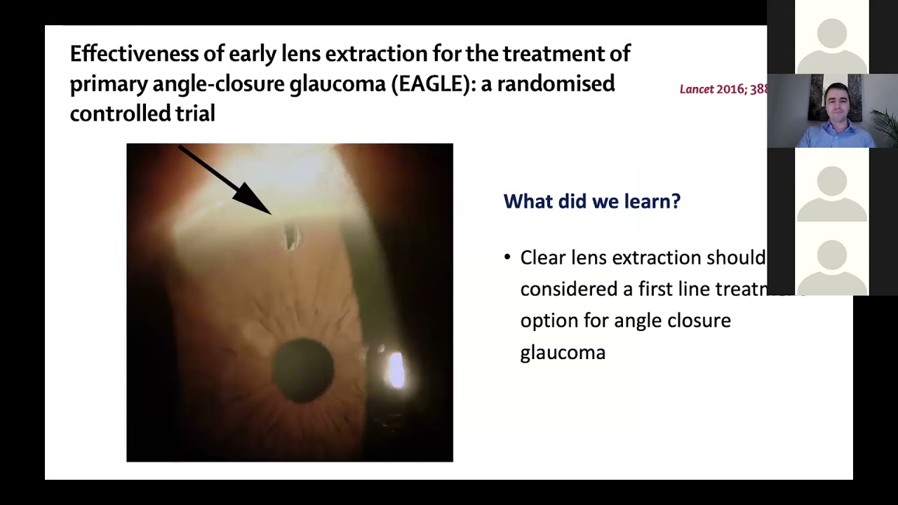 Glaucoma Support Group: Glaucoma research