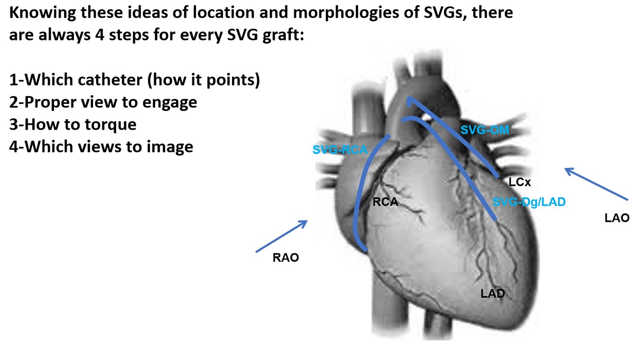 Graft engagement and imaging: step-by-step case illustration- Elias Hanna, Univ Iowa