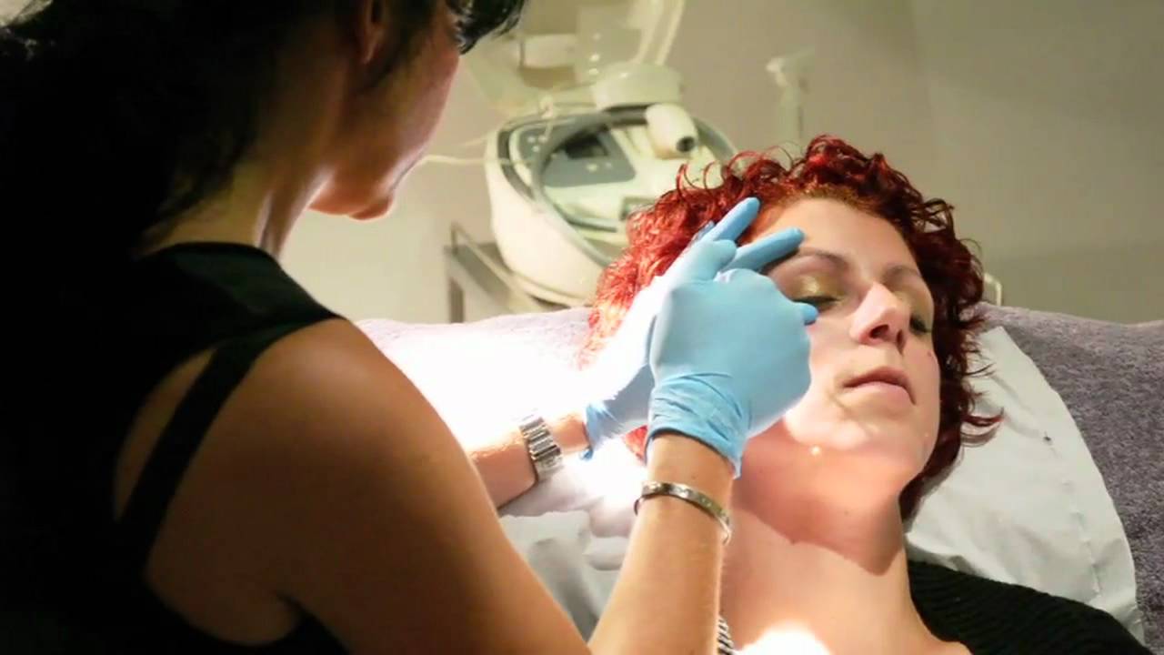 Cheek Fillers Before & After at Tracey Bell