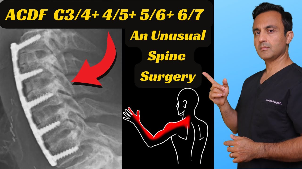 Четырехуровневая операция ACDF: как это делается