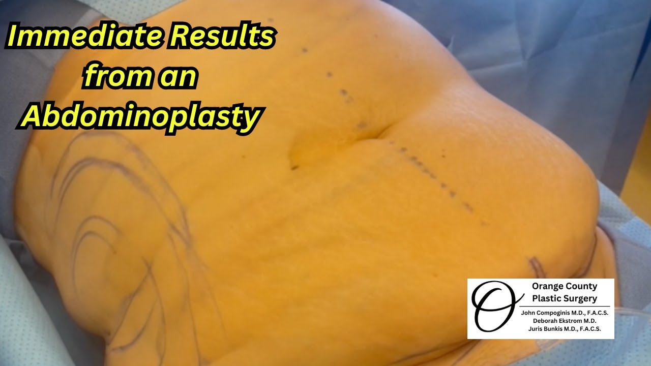 Immediate Results after a Tummy Tuck| Orange County Plastic Surgery #plasticsurgeryresults