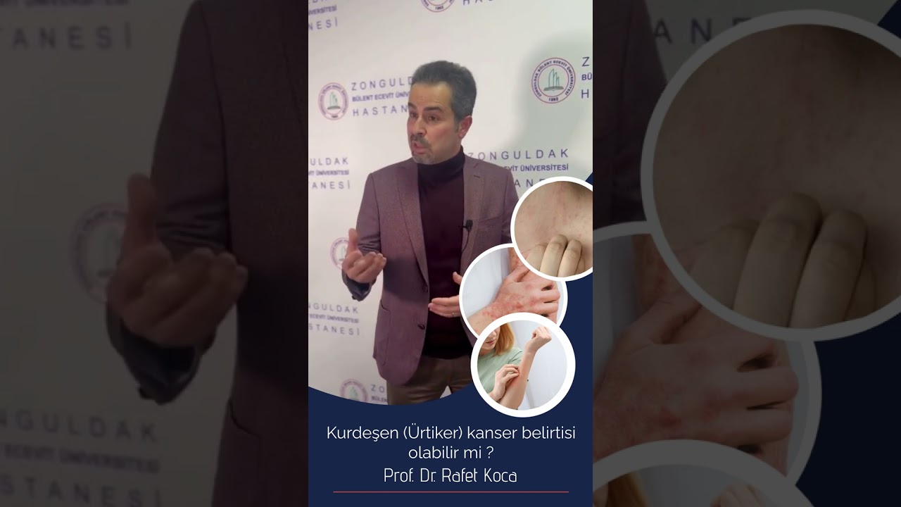 Kurdeşen (&Uuml;rtiker) kanser belirtisi olabilir mi ? #kanser #kurdeşen #dermatology