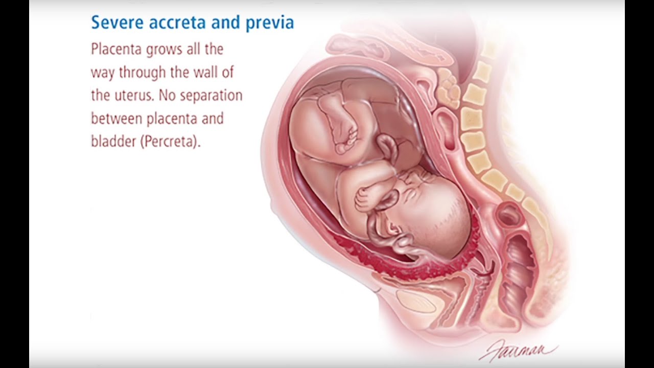 Introduction to Placenta Accreta Video - Brigham and Women's Hospital