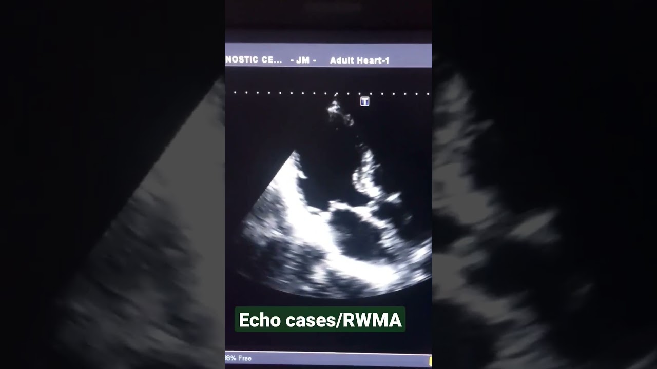 echo cases/RWMA