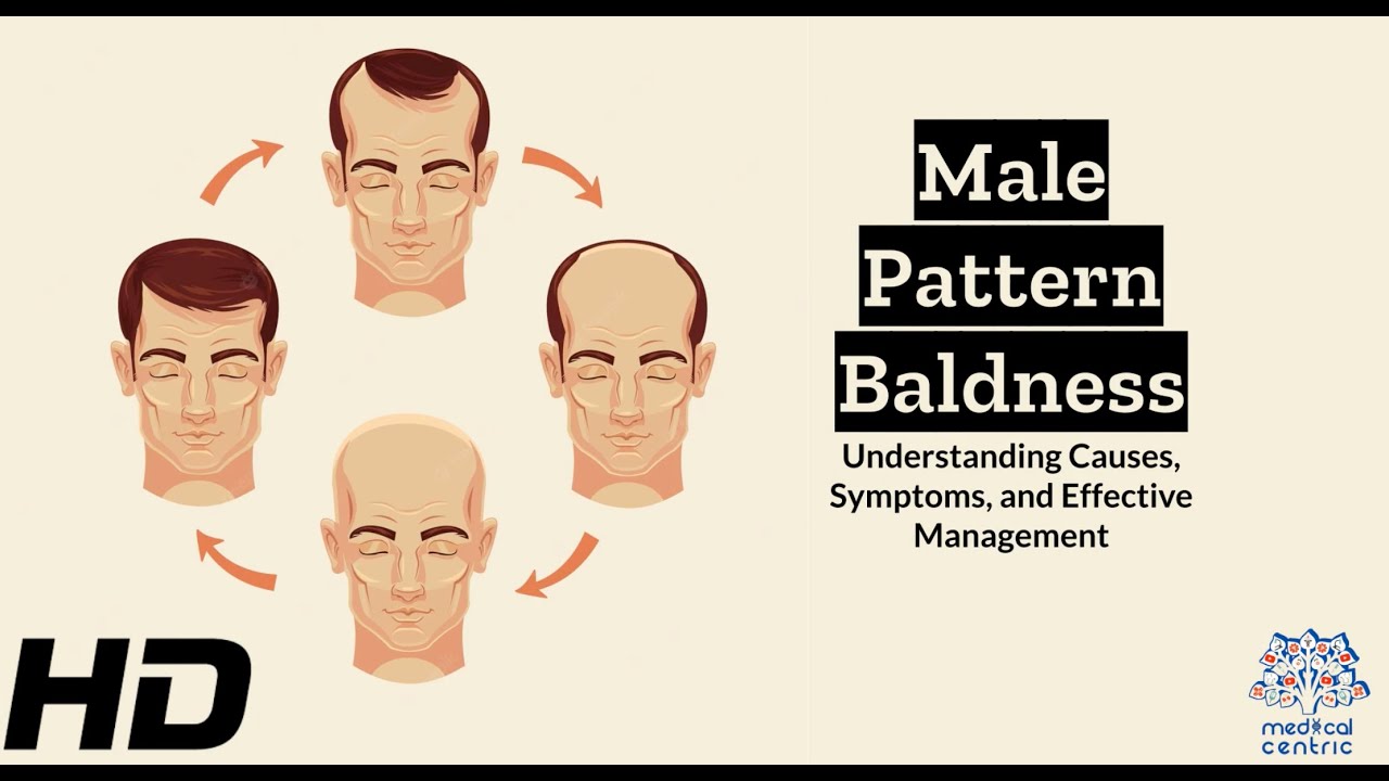 Male Pattern Baldness Explained: Everything You Need to Know