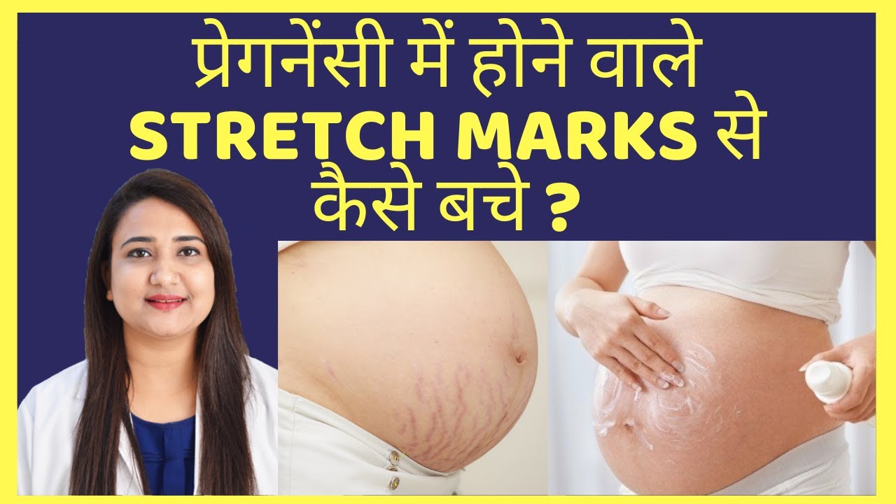 प्रेगनेंसी में STRETCH MARKS से कैसे बचे ? कैसे दूर करे ?