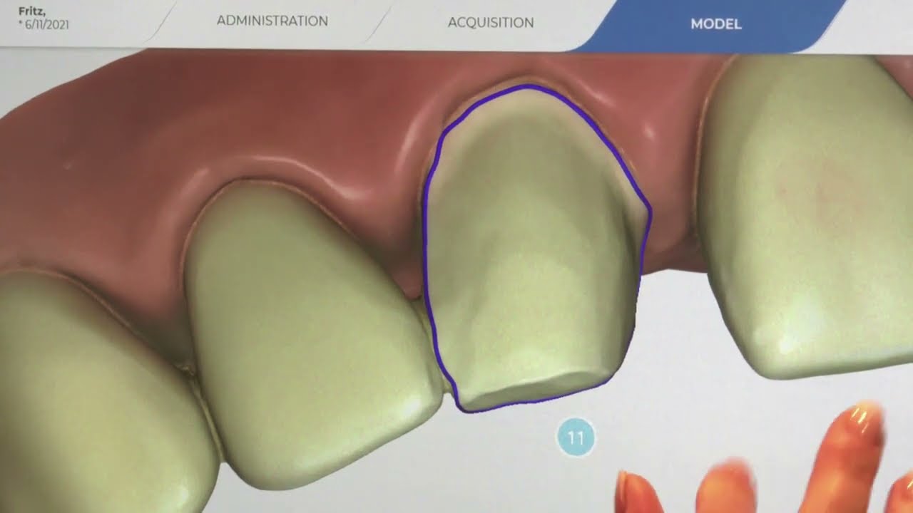 Etape realizare FAȚETĂ DENTARĂ tehnica CAD/CAM pe simulator | Dr Anca Vereanu
