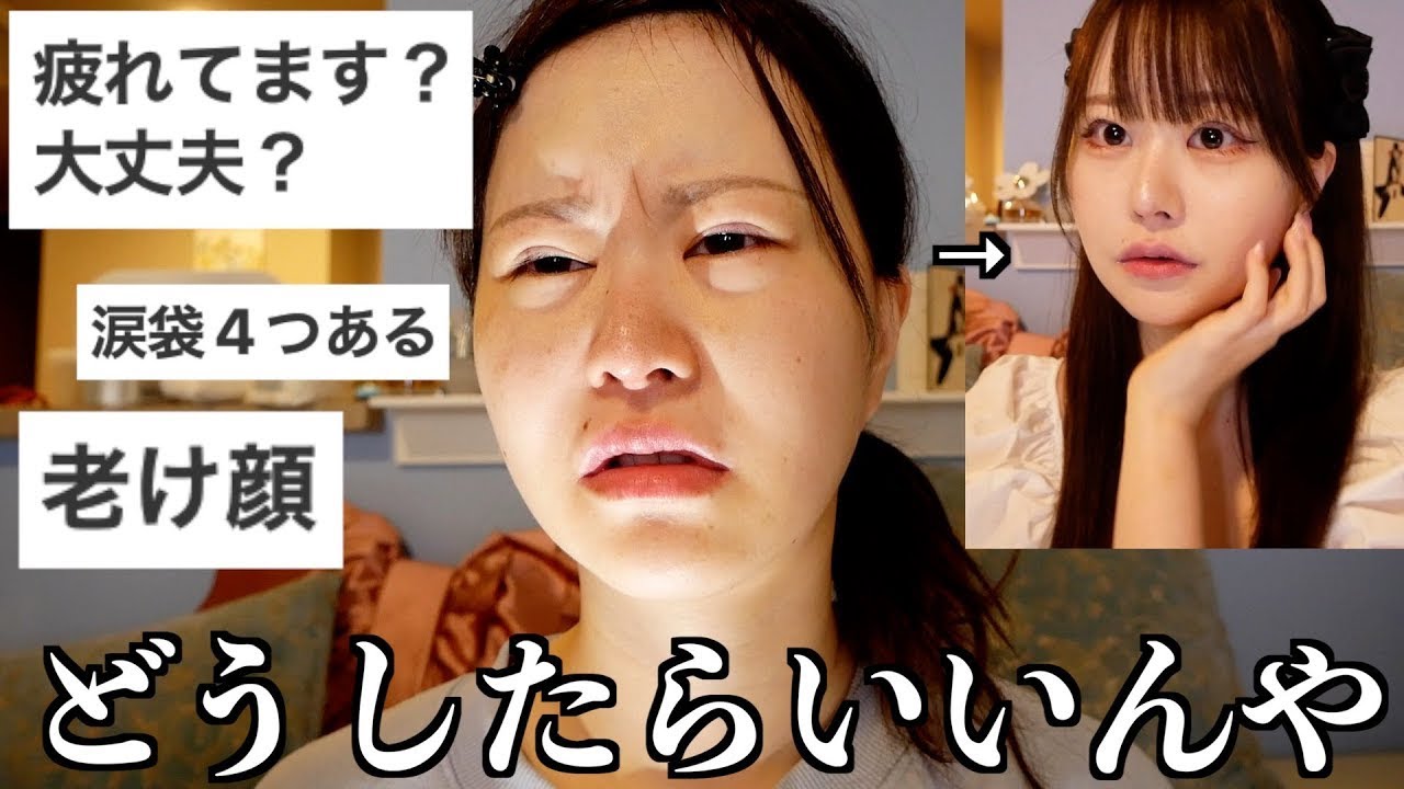【くま取り整形】ダウンタイムまで全部見せます