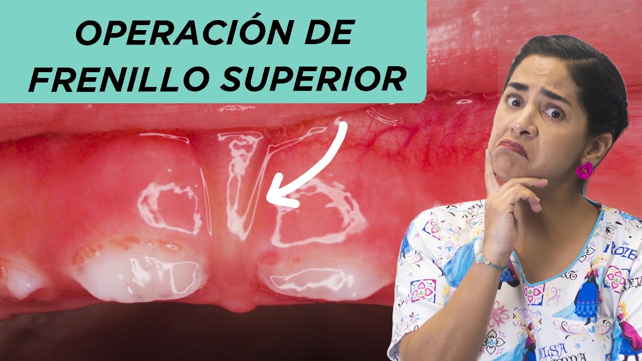 ⚠️ Operación de frenillo superior