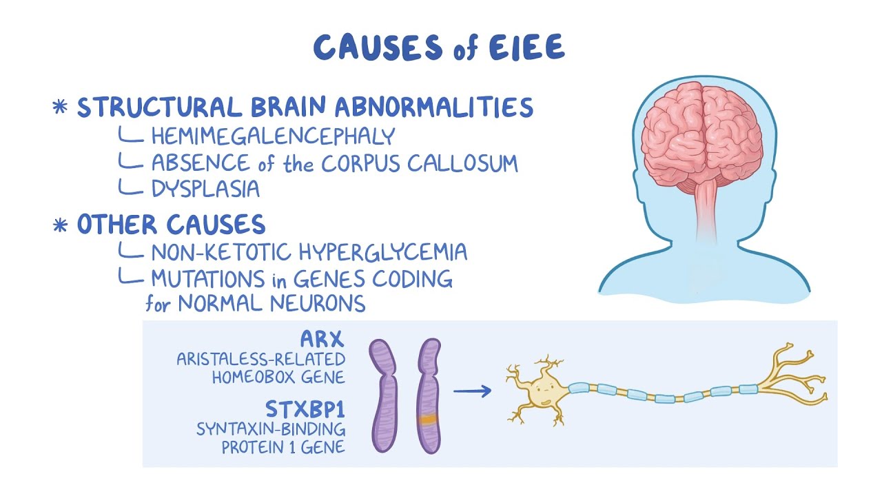 Understanding Early Infantile Epileptic Encephalopathy (EIEE): Rare Seizure Disorder