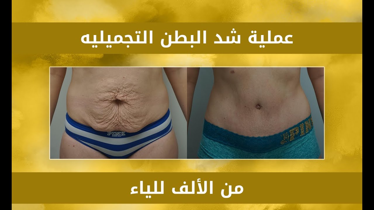 عملية شد البطن التجميليه TUMMY TUCK