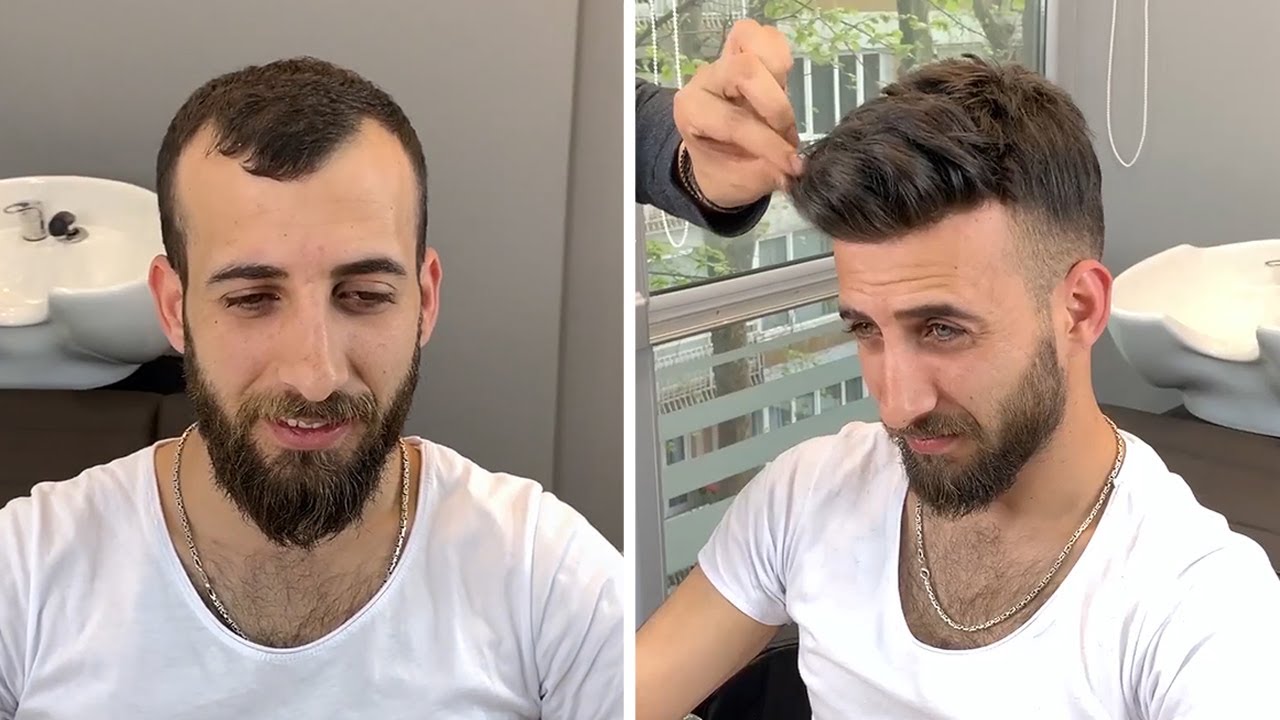 Protez Saç Ekimi Uygulaması - Hair Replacement