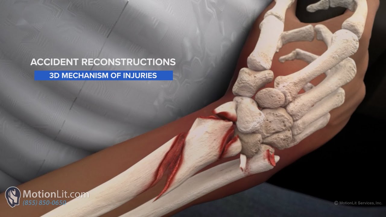 3D Animation Shows Mechanism of Compound Wrist Fracture Injury