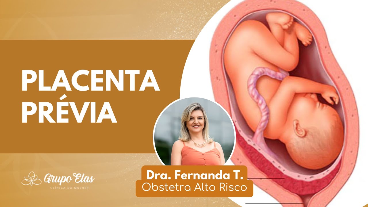PLACENTA PRÉVIA - Dra. Fernanda Torino | Ginecologia e Obstetrícia de Alto Risco