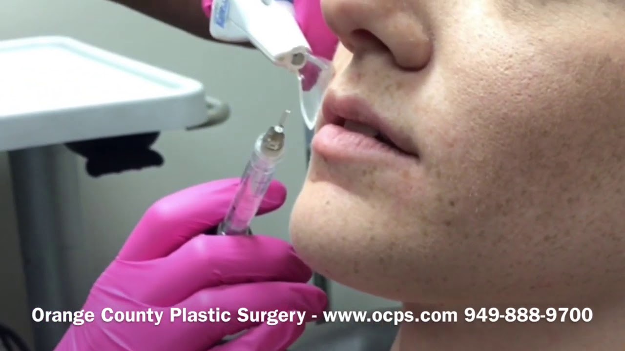 Lip Injections At Orange County Plastic Surgery
