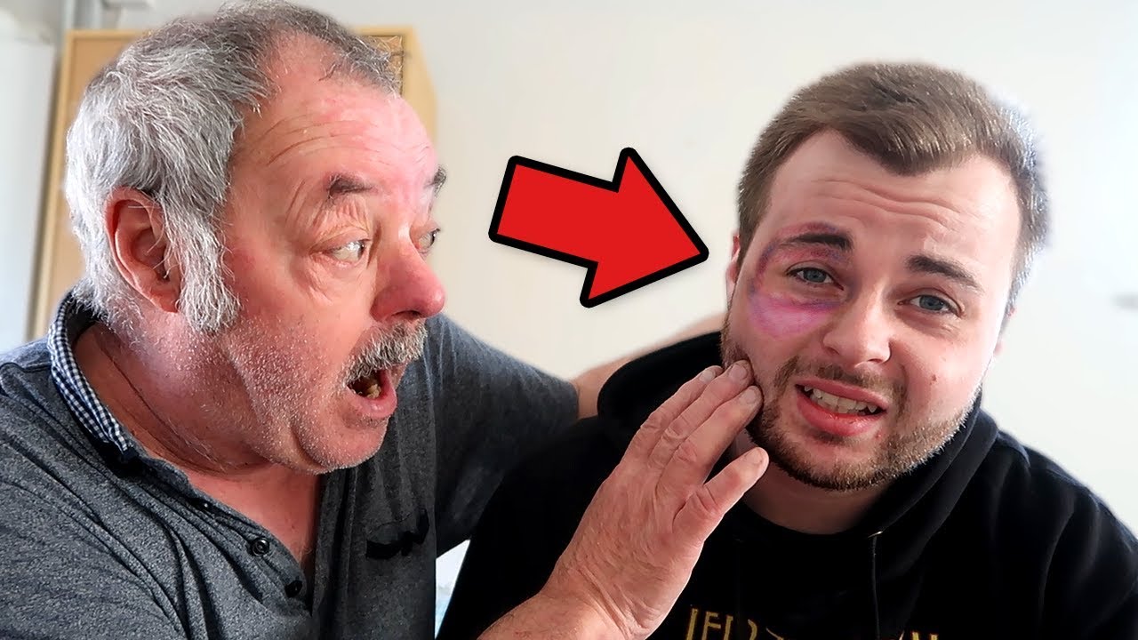 BLACK EYE PRANK ON MY DAD