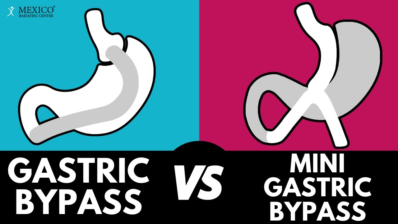 Gastric Bypass VS Mini Gastric Bypass
