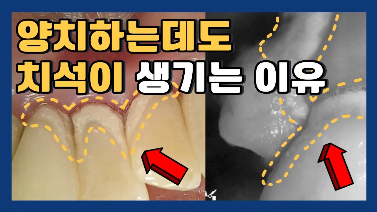 치석이 잘 생기는 이유, 내가 더 관리하는데 왜... 치석이 생기는 부위, 치석 잘생기는 사람