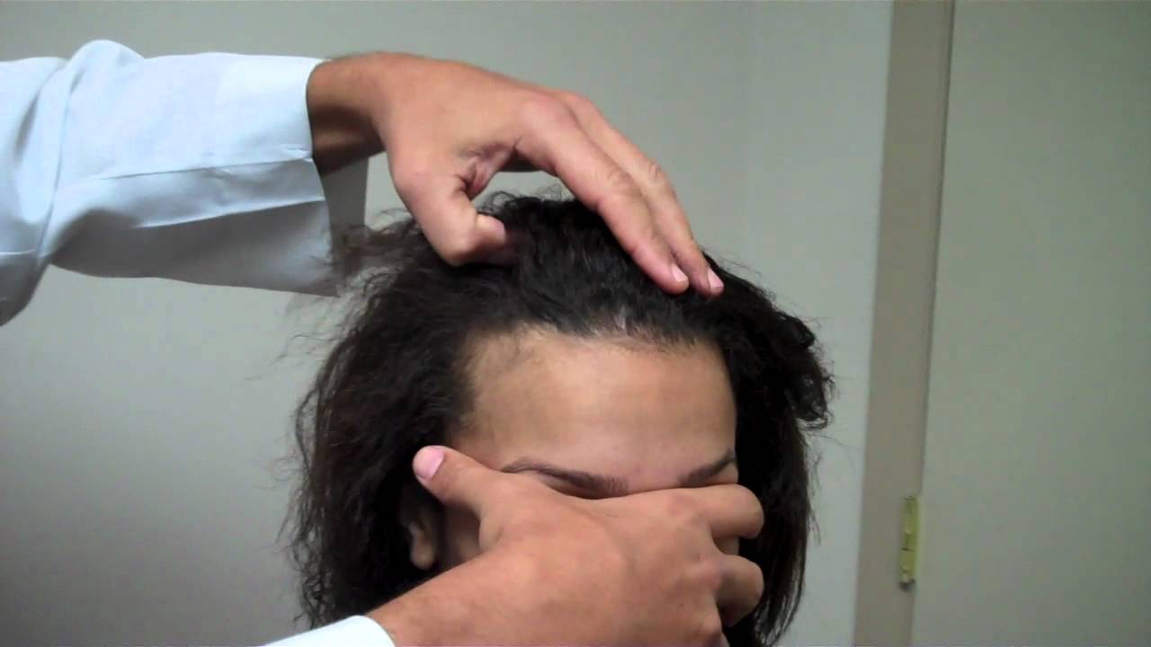Dr Jeffrey Epstein - Mark Up for Surgical Hairline Advancement - Female Patient