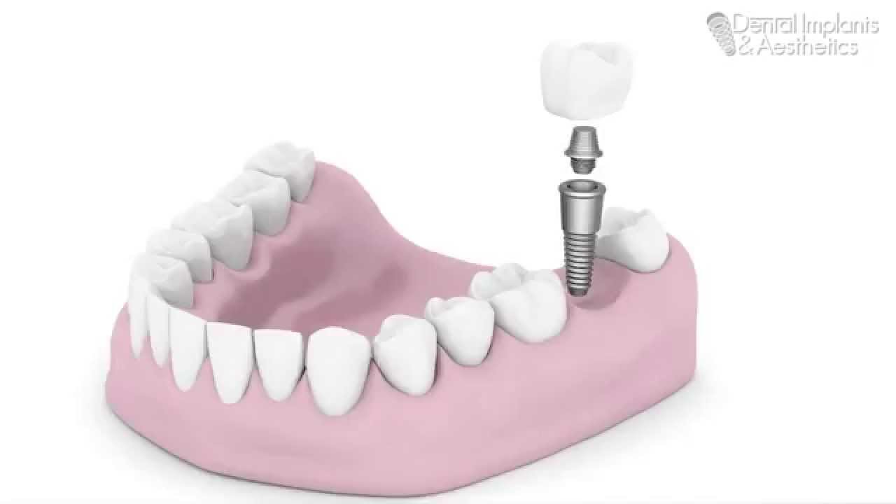 Dental Implants and Aesthetics - Gold Coast Clinic