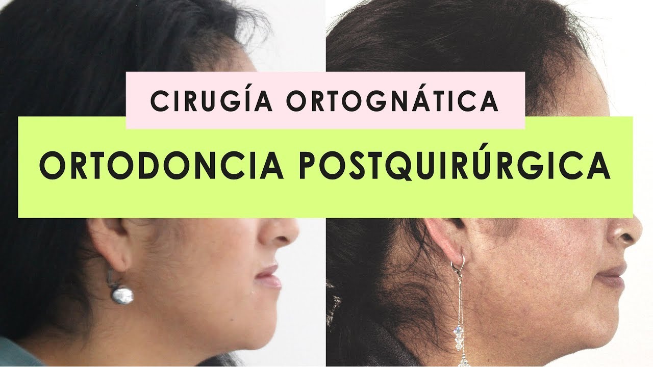 ORTODONCIA POSTQUIRÚRGICA | DESPUÉS DE LA CIRUGIA ORTOGNÁTICA