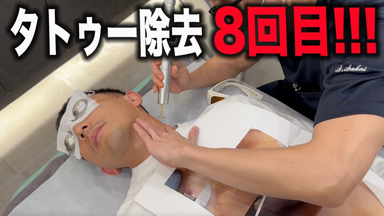 首のタトゥー除去ついに完結1回目から全て公開します‼️