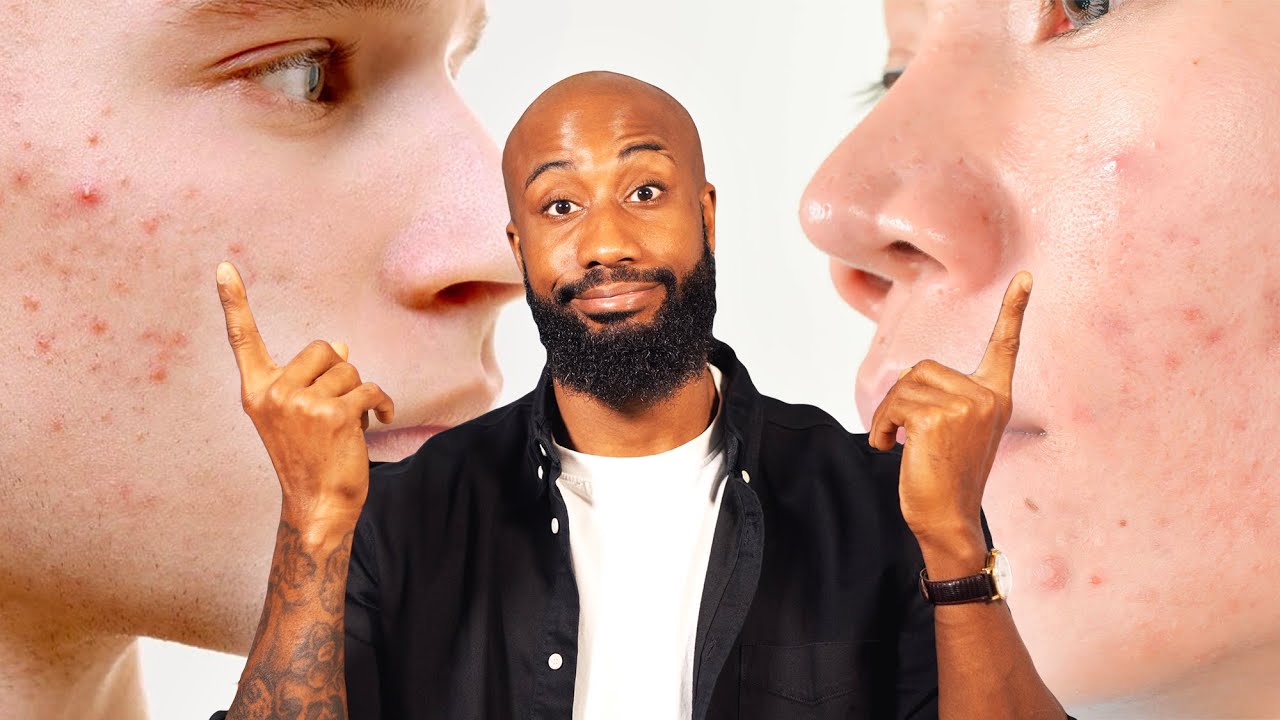 🧼 COMMENT TRAITER L'ACNÉ ( excès de sebum, comédons, peaux grasses)