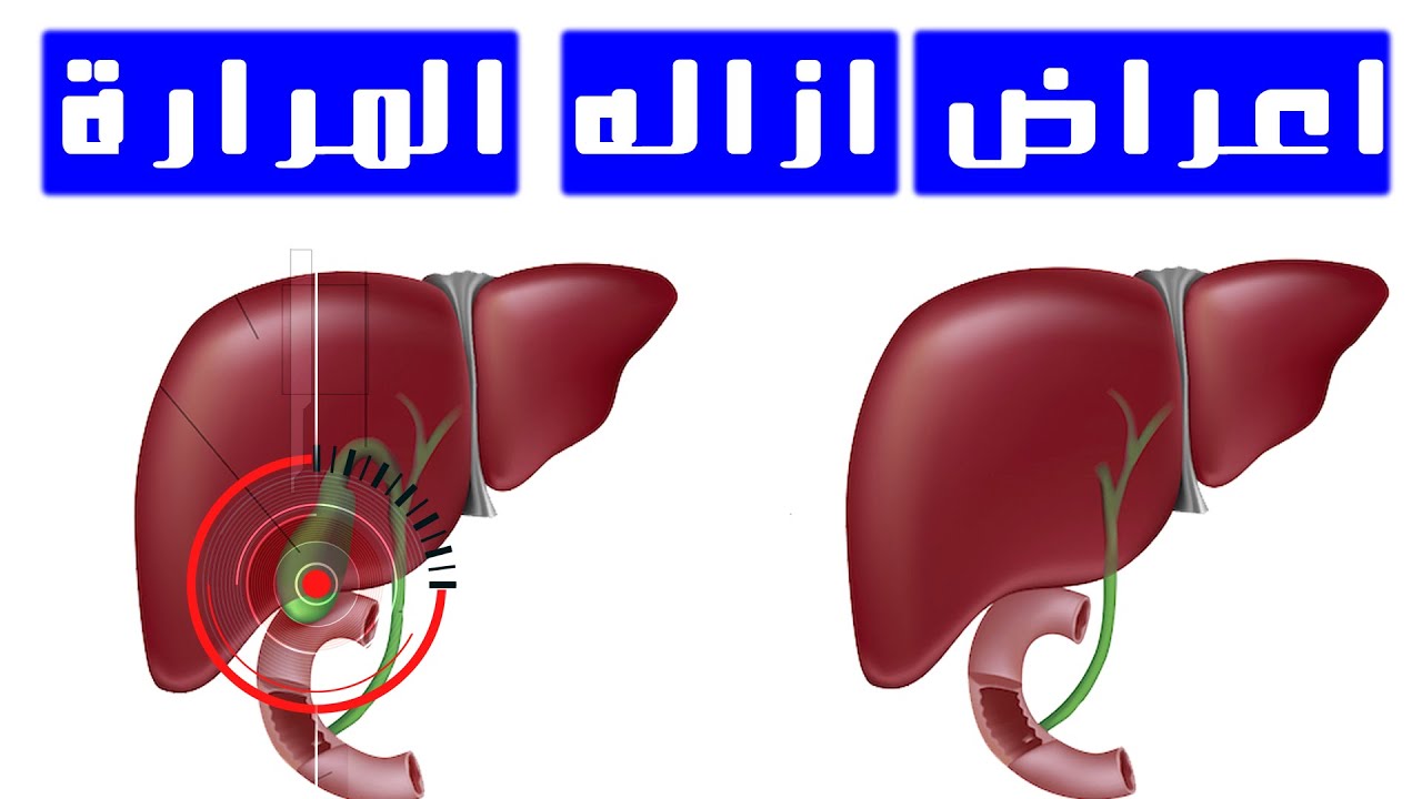 اعراض خطيره لاستئصال او ازاله المراره || الإسهال الغازات فقر الفيتامينات || تعلم التعامل معها الان
