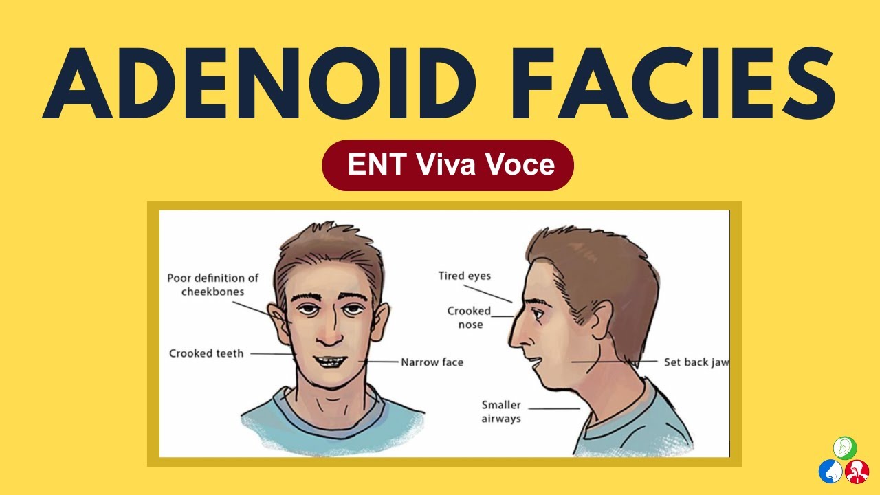 Adenoid Facies | ENT Viva Voce
