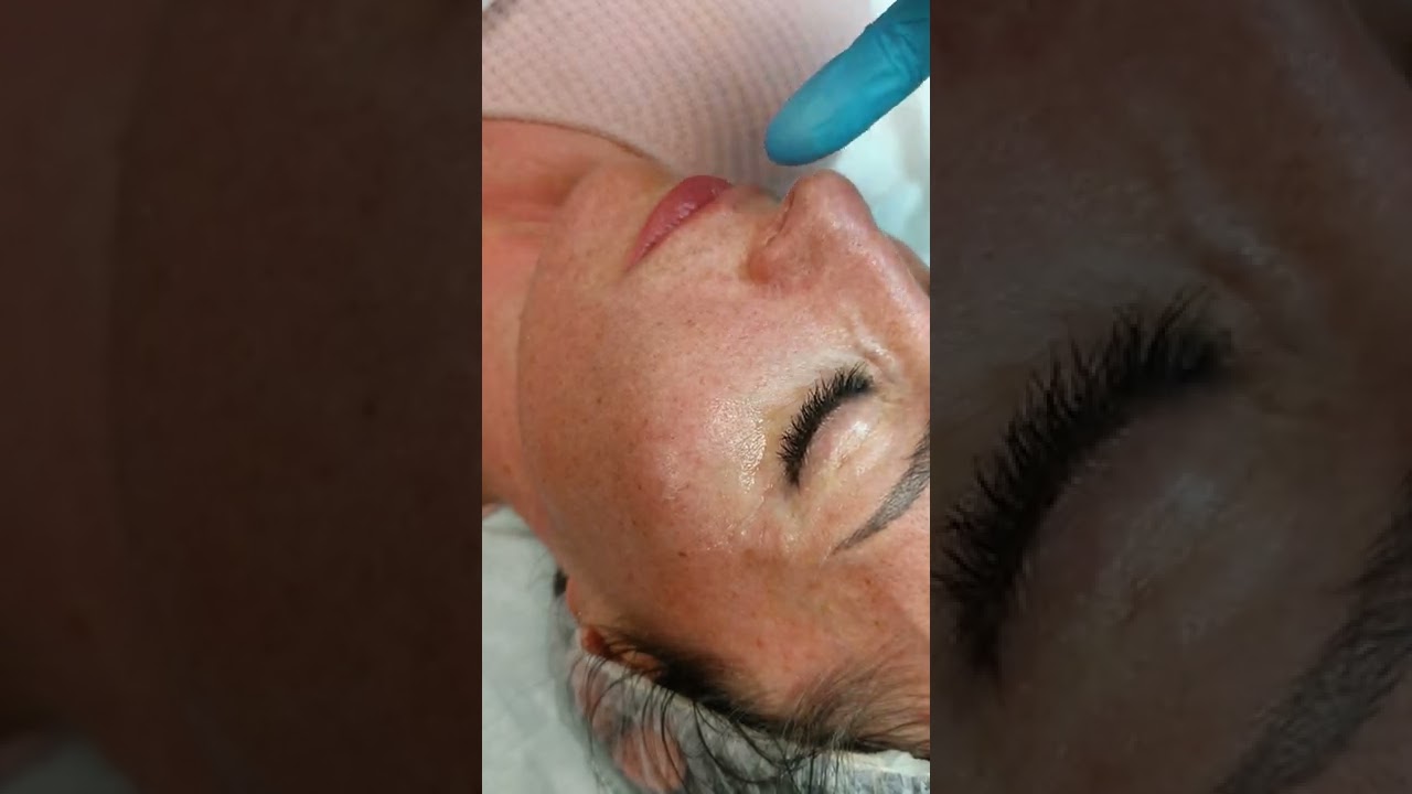 como colocar Hilos tensores de colageno.