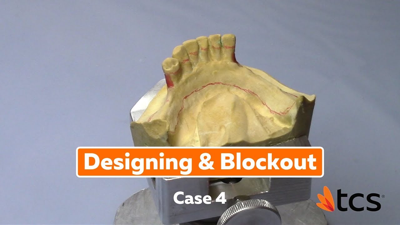 Designing & Blockout Case 4 - Designing Long Free End Saddles
