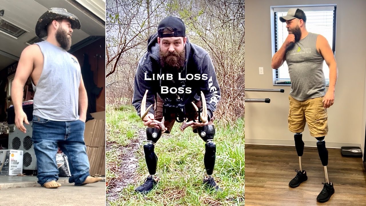 Кто такой Limb Loss Boss? 3 миллиона просмотров свидетельства - Моя жизнь до, во время и после ав...