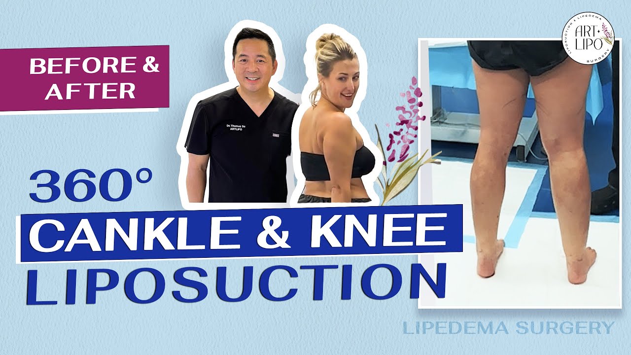 LIPEDEMA LIPOSUCTION |  360&deg; CANKLE & KNEE LIPOSUCTION | Artlipo | Expert  Dr. Thomas Su