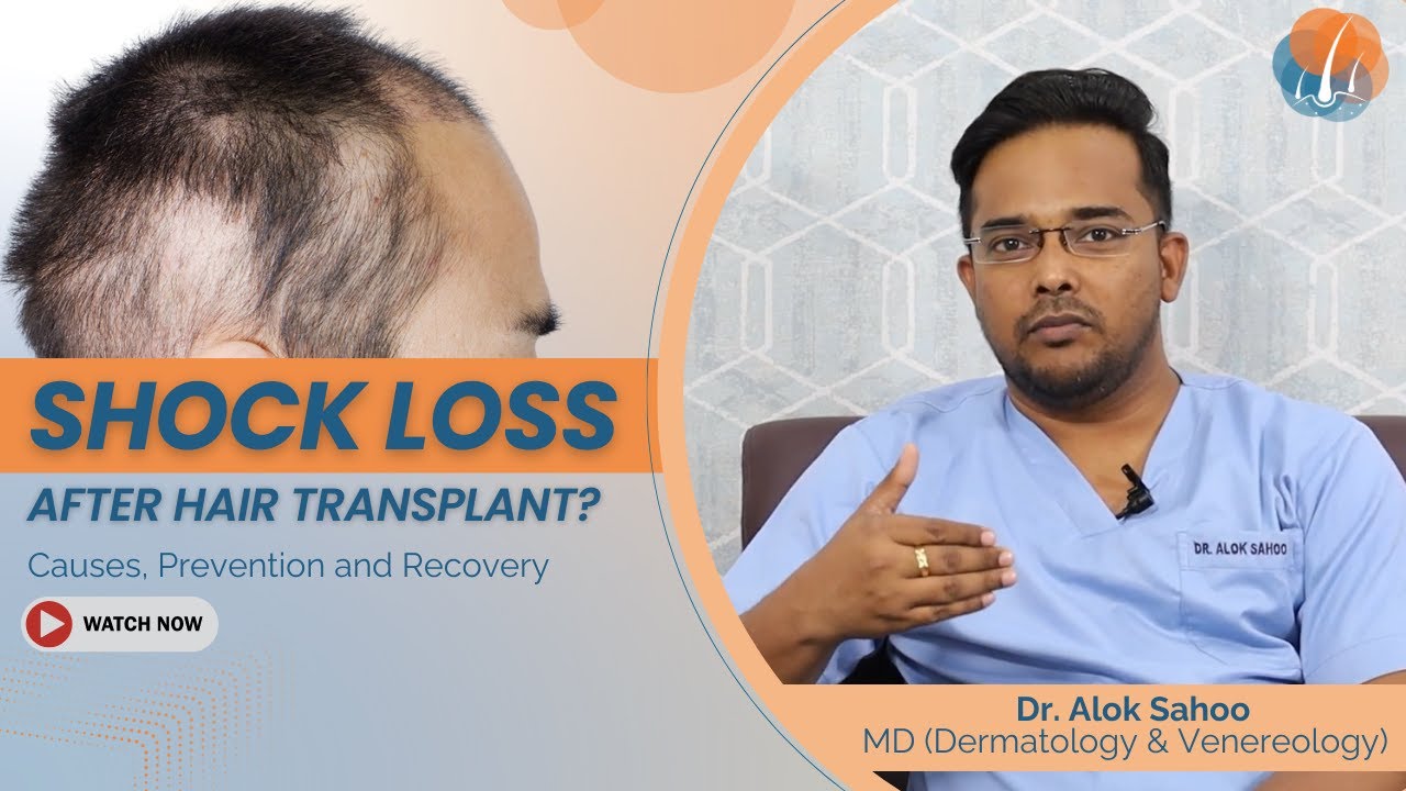 Shock loss after a hair transplant? | Know the causes, prevention, and recovery | Dr Alok Sahoo