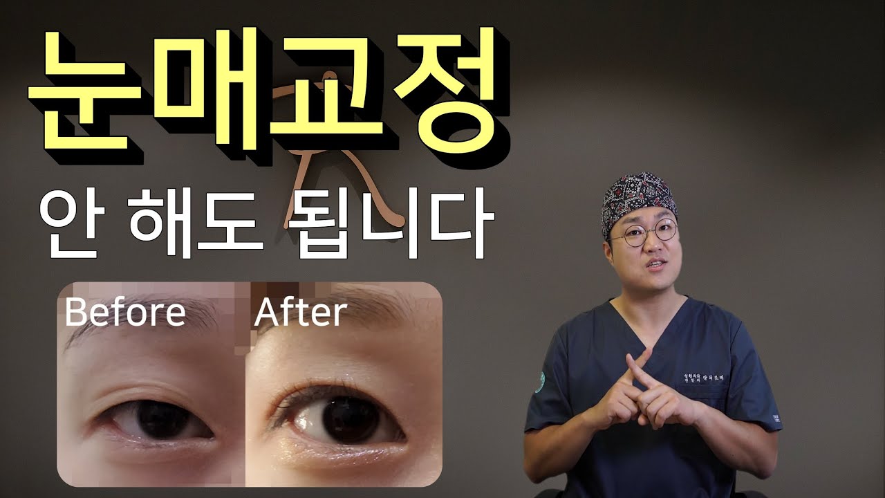 눈매교정 안해도 되는 눈.  눈매교정 없이 눈이 커질 수 있음에도 눈매교정술을 권유받기 쉬운 눈의 형태와 누구나 쉽게 그 여부를 판단할 수 있는 기준을 알려드릴게요.