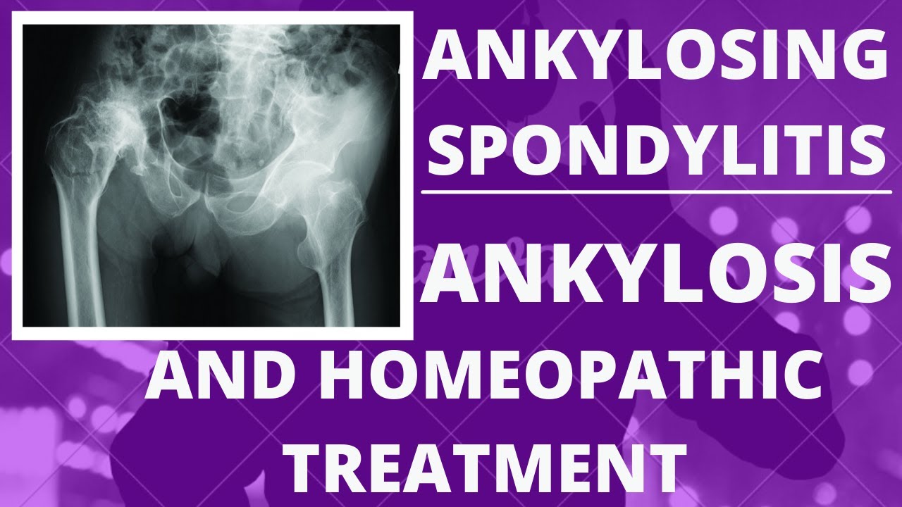 ankylosing spondylitis || ankylosing spondylitis homeopathic treatment in hindi !