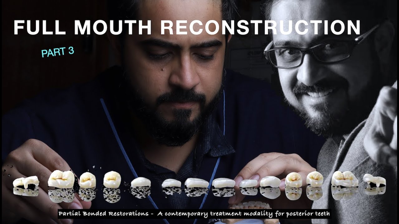Full Mouth Reconstruction using Table Top Concepts: Part 3 #FMR #Bruxism