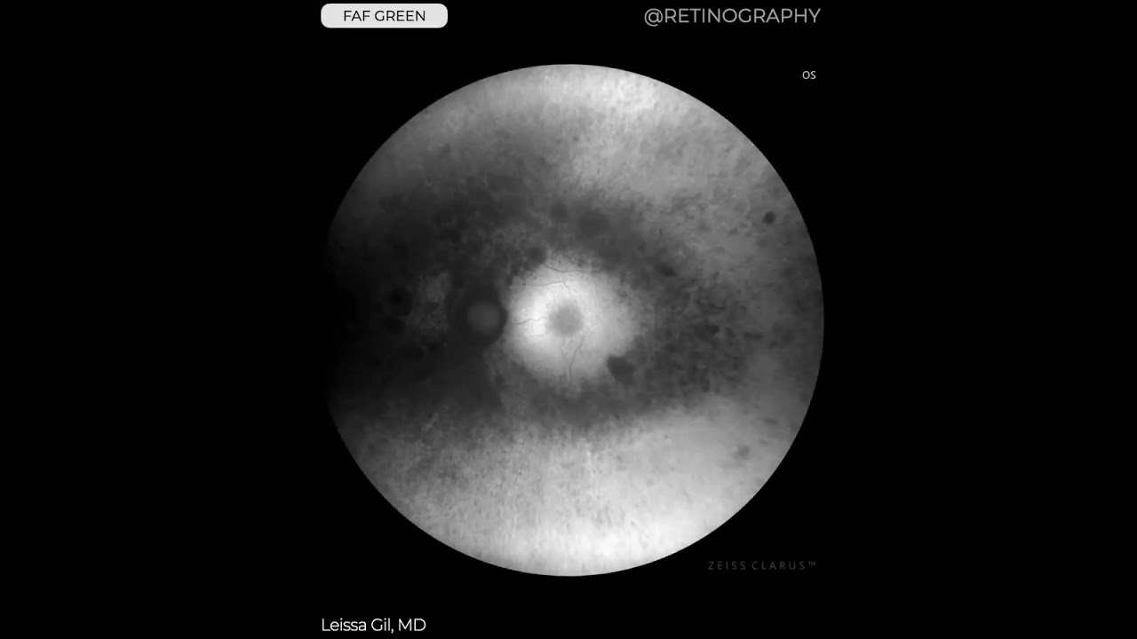 RETINITIS PIGMENTOSA MULTIMODAL ANALYSIS For more images like this visit www.retinography.org #retin