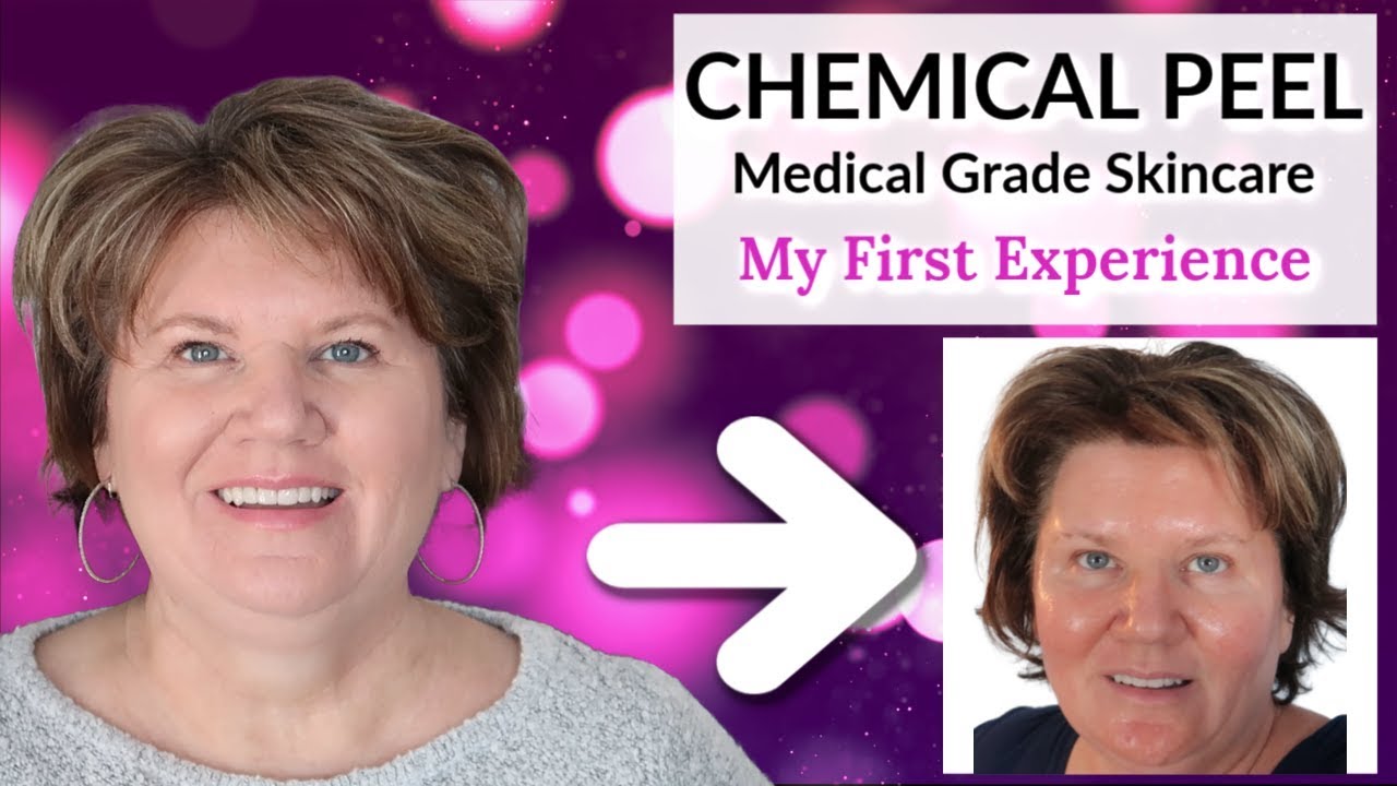 My First Chemical Peel OVER 50 - Was It Worth The Money?
