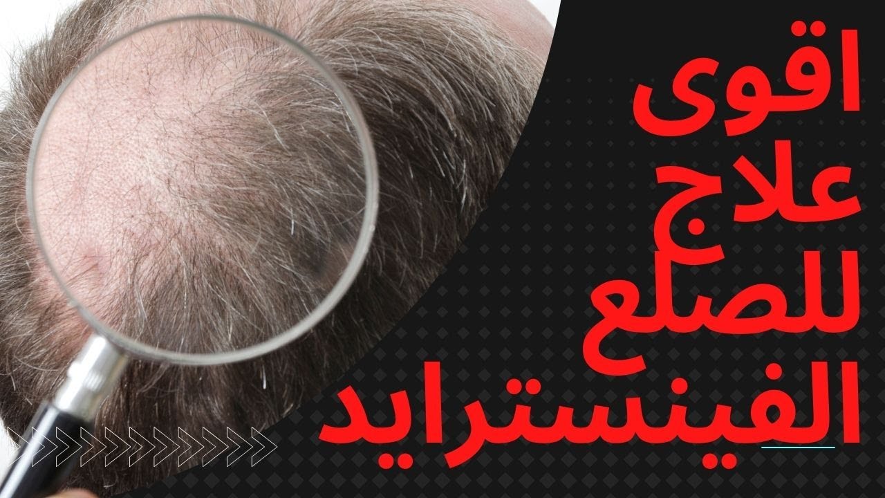 حبوب الفينسترايد لعلاج الصلع الوراثي المستشار سامي