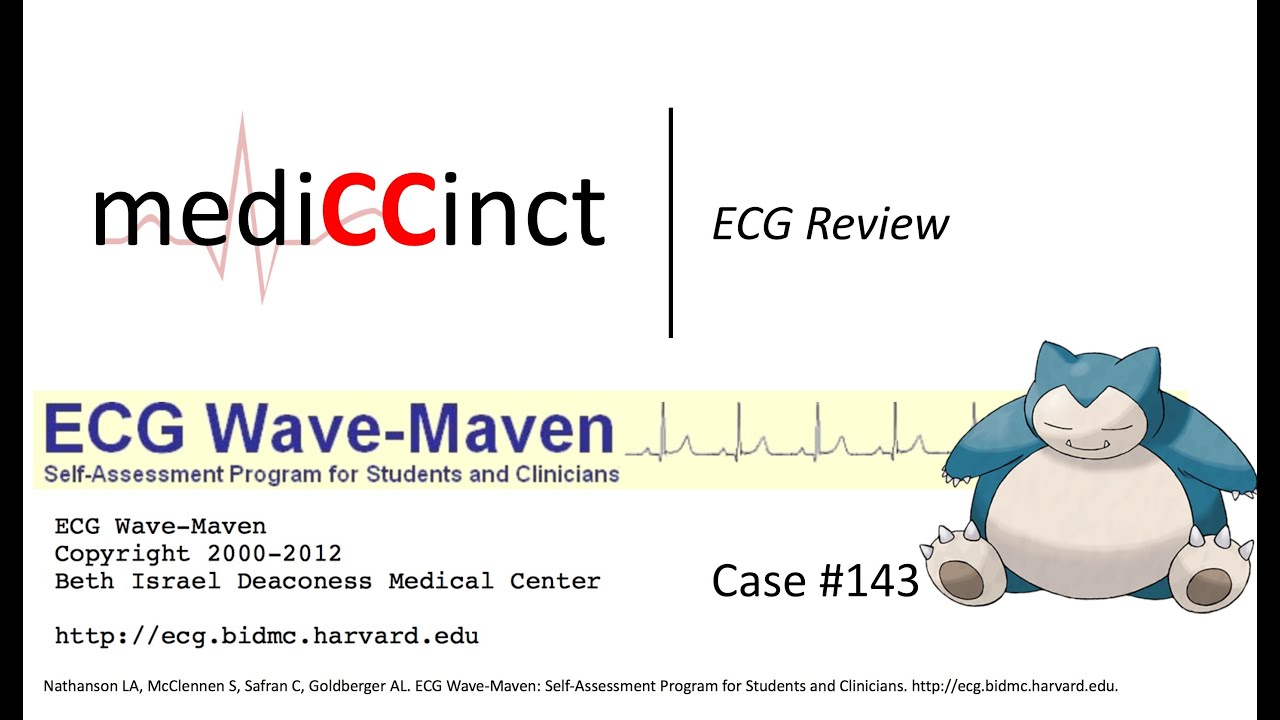 Ventricular Tachycardia & Underlying Sinus Tachycardian & AV Dissociation (ECG Wave-Maven) Case #86