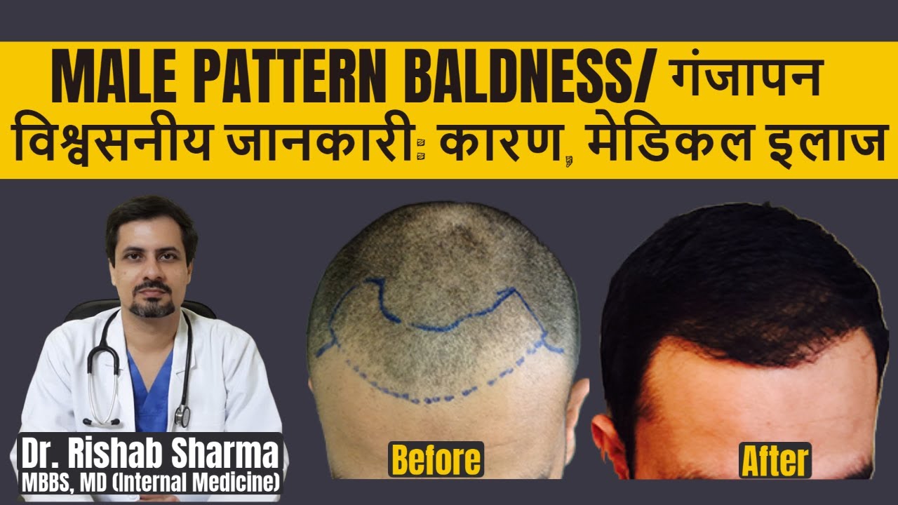 Causes, Best Treatment, Home Remedies (In Hindi) I Androgenic Alopecia I Male Pattern Baldness Cure