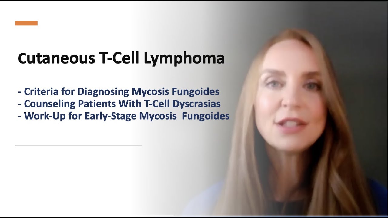 CTCL: Criteria to Diagnose, Counsel Patients, and Work-Up for Early-stage Mycosis Fungoides