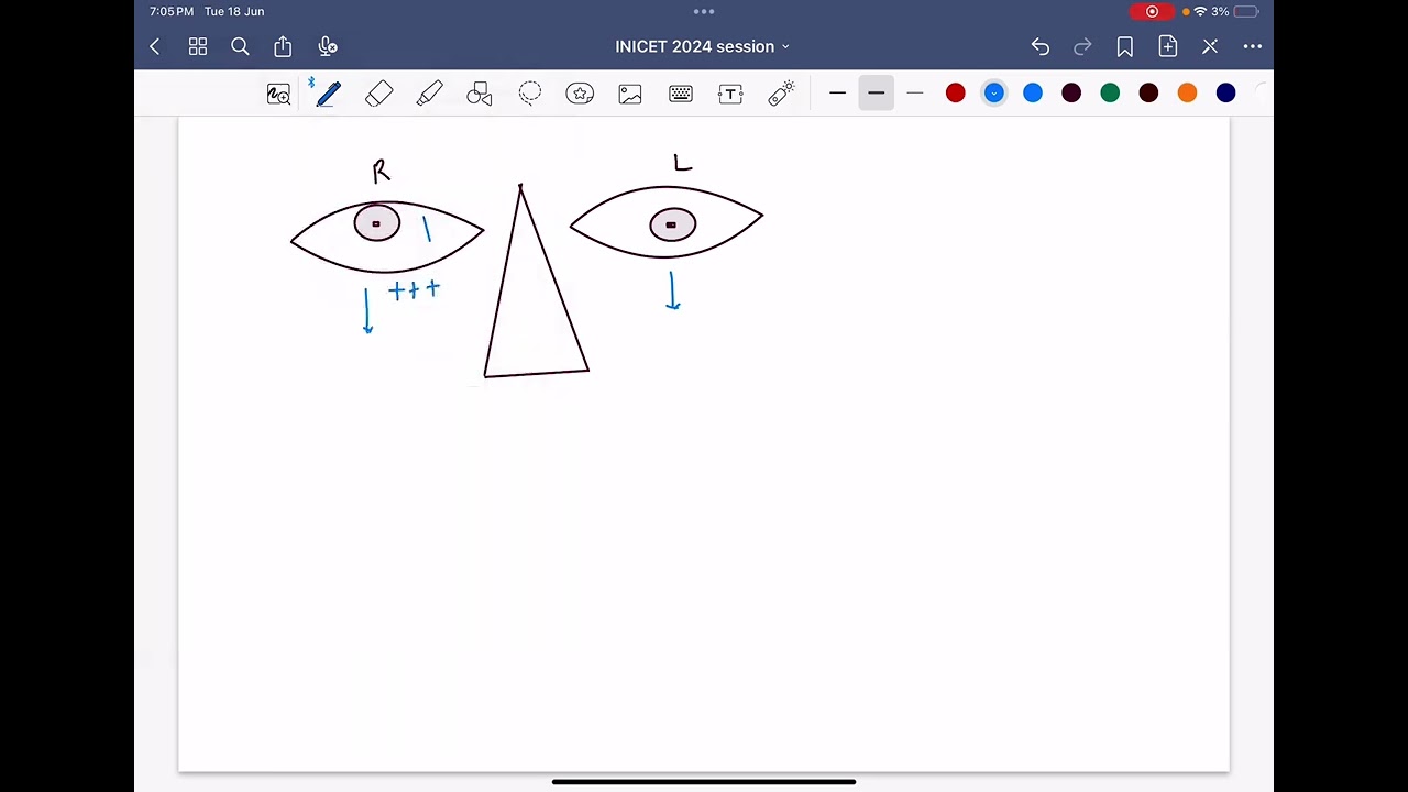 Diplopia in superior oblique palsy